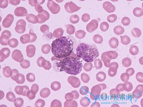 丈夫白血病妻子引产