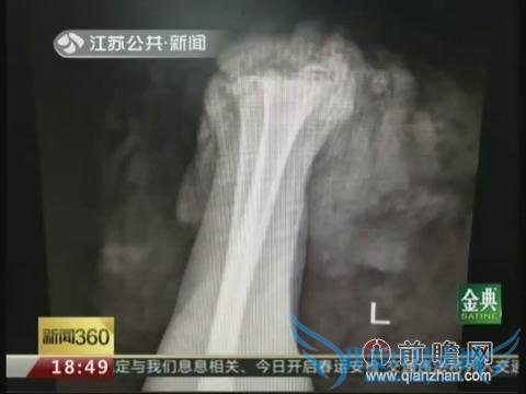 男生为戒网瘾砍断左手