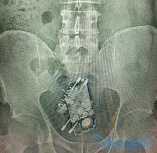 什么都敢吞!巴西一囚犯将手机和充电器吞进肚子藏起来