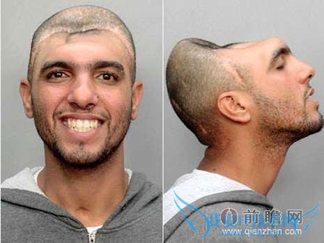 男子车祸后成半脑人 仍保住一条命