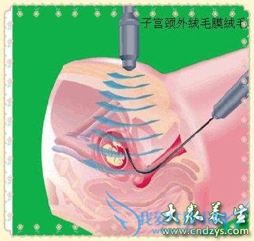 ��ëĤȡ������Ѽ��ʱ��,��ëȡ������Ҫ�ŵ�(1)