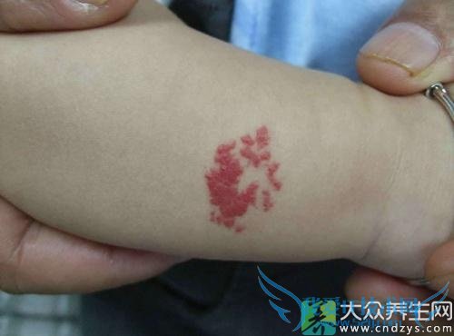 Ѫ������֢״