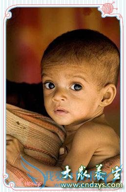 С��Ӫ��������֢״��Щ����ҪäĿ�ĸ����ӽ���(2)