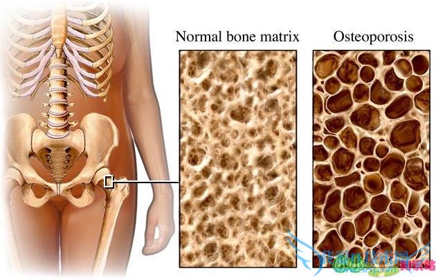 因骨质疏松引起的膝关节疼痛因如何治疗 因骨质疏松引起的膝关节疼痛因如何治疗