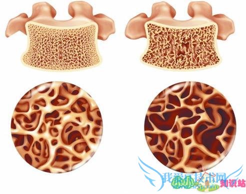 因骨质疏松引起的膝关节疼痛因如何治疗 因骨质疏松引起的膝关节疼痛因如何治疗
