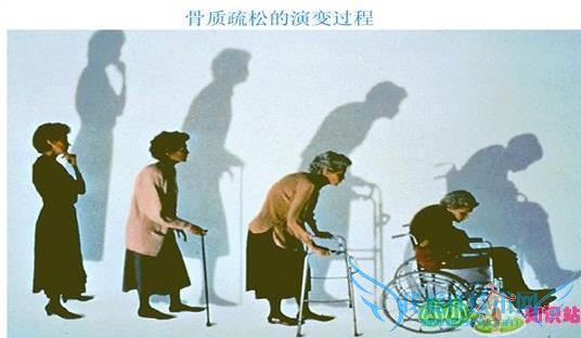 因骨质疏松引起的膝关节疼痛因如何治疗 因骨质疏松引起的膝关节疼痛因如何治疗