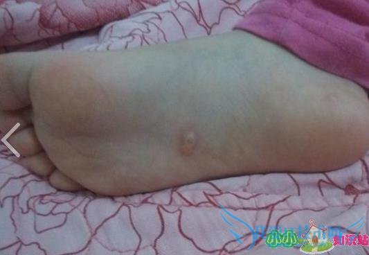 小孩摔跤磕破嘴唇长好后有个小包有点硬还能长 小孩摔跤磕破嘴唇长好后有个小包有点硬还能长