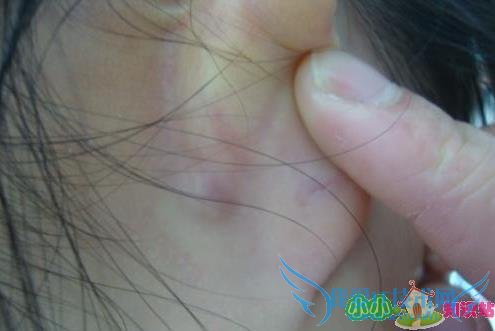 小孩摔跤磕破嘴唇长好后有个小包有点硬还能长 小孩摔跤磕破嘴唇长好后有个小包有点硬还能长