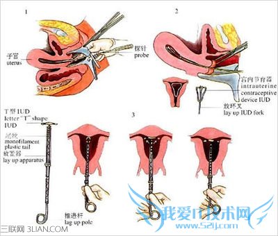 上环避孕的原理 52IJ母婴教育