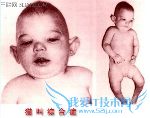 什么是猫叫综合征 52IJ母婴教育