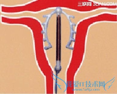 上节育环避孕4注意 52IJ母婴教育