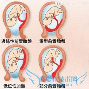 胎盘厚度与胎盘成熟度有关吗 52IJ母婴教育