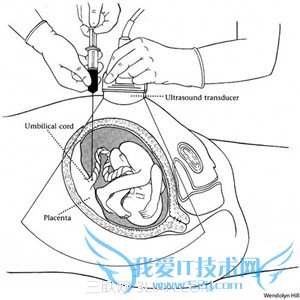 羊水穿刺能查出什么 52IJ母婴教育