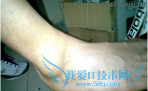 脚崴了肿了的解决方法 52IJ