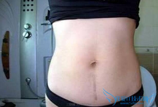 剖腹产后怎样进行腹部美容 52IJ母婴教育