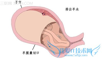 剖腹产后多久来月经 52IJ母婴教育