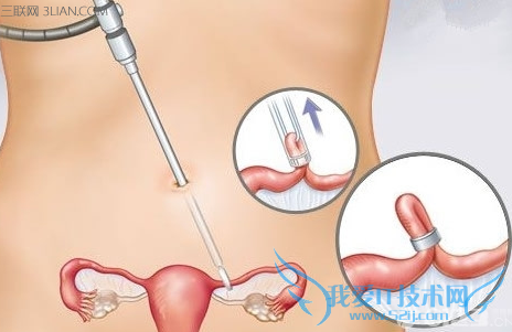 结扎后多久可以同房 52IJ母婴教育