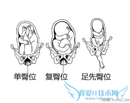 剖腹产的劣势 52IJ母婴教育