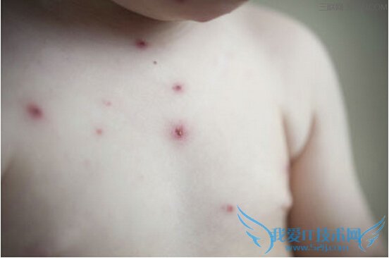 Ë®¶»»¼¶ùÔõÑù»¤Àí¼°·ÀÖÎ ÈýÁª