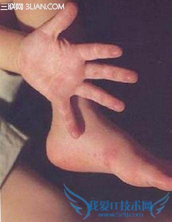 手足口病前期症状及需注意的饮食和卫生 52IJ母婴教育