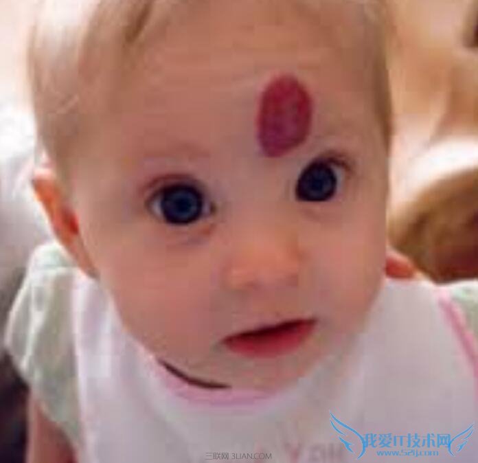 胎记怎么去除 胎记是怎么形成的 三联