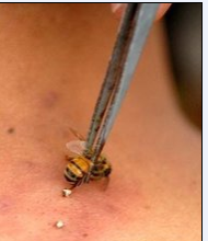 旅游时被野蜂螫伤了怎么办