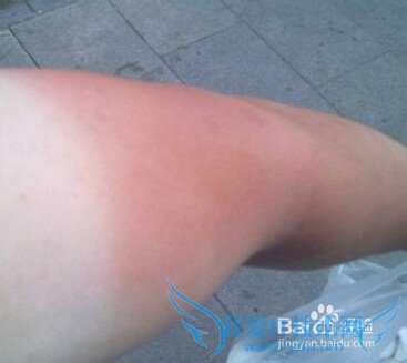 日光性皮炎用什么药膏?去旅游回来出现的