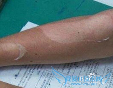 日光性皮炎用什么药膏?去旅游回来出现的