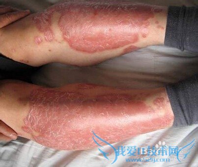 日光性皮炎用什么药膏?去旅游回来出现的