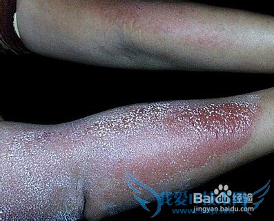 日光性皮炎用什么药膏?去旅游回来出现的