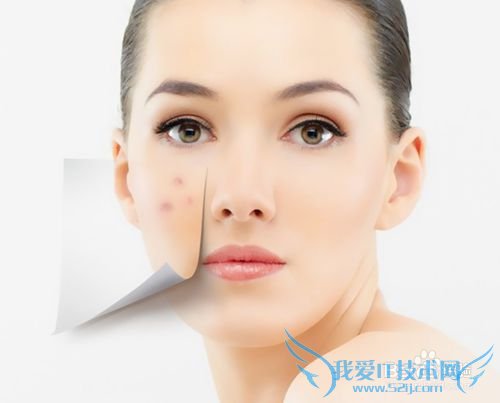 火山泥的功效作用/火山泥能祛痘祛黑头吗